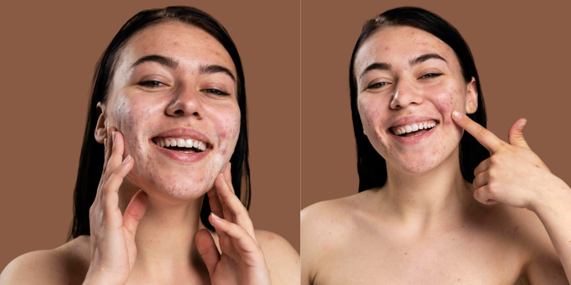 What's the Best Way to Treat Acne Without Harsh Chemicals?